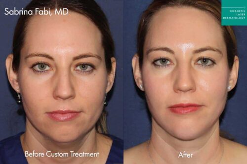 before and after dermal fillers
