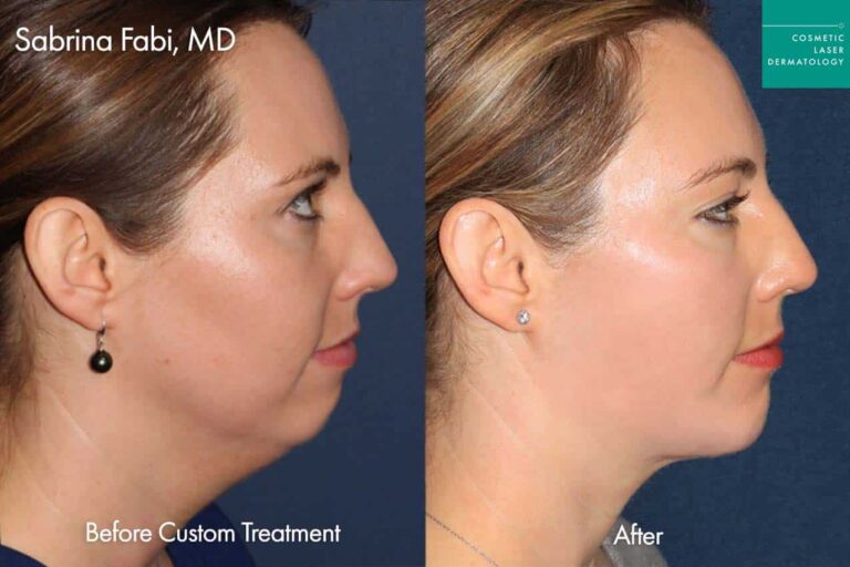 Custom neck liposuction treatment San Diego CA.