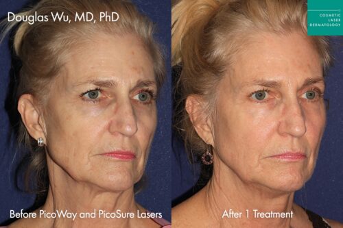 before and after picosure laser