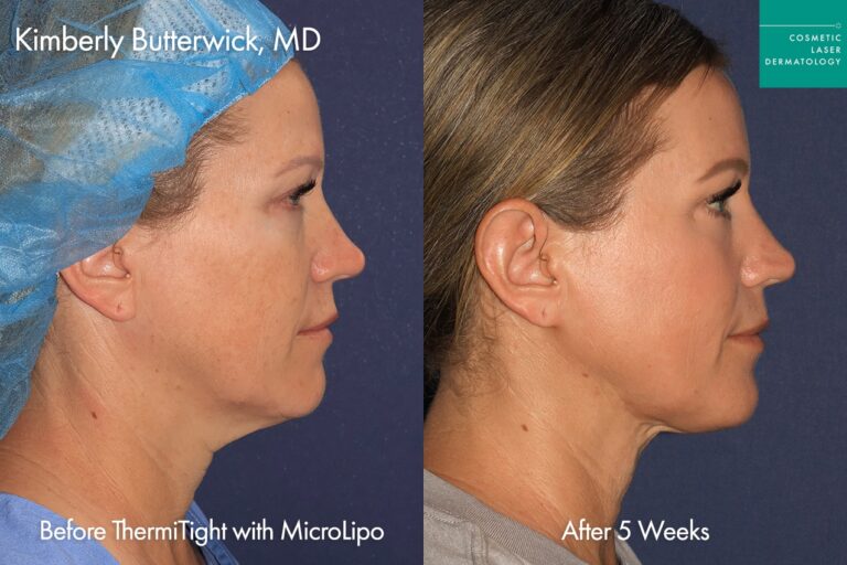Before and after side image of Thermi Neck contouring performed by Dr. Butterwick at our San Diego medical clinic