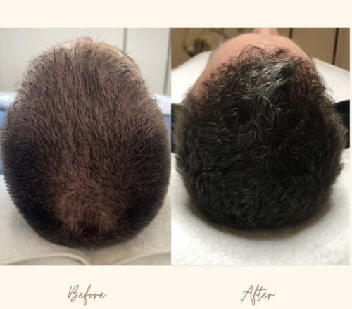 hair restoration before and after photos