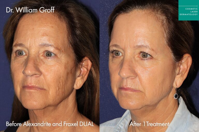 fraxel dual treatment female before and after clderm san diego