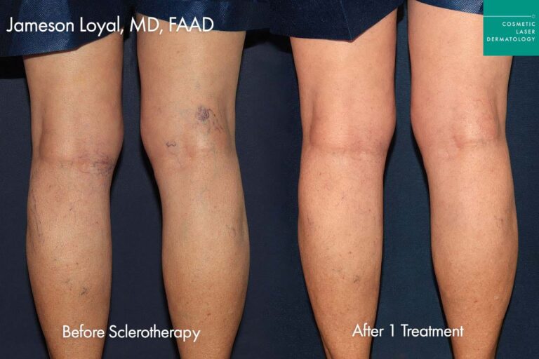sclerotherapy vein treatment san diego before and after female