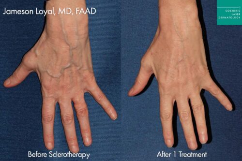 Radiesse for hand rejvuenation in San DIego