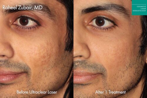 before and after Indian skin care treatment for scars in san diego