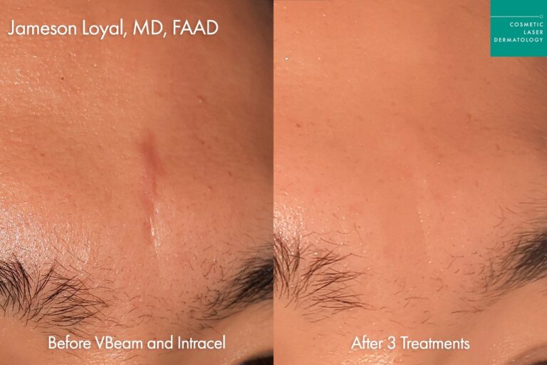 vbeam prima treatment to remove scar forehead clderm san diego before and after