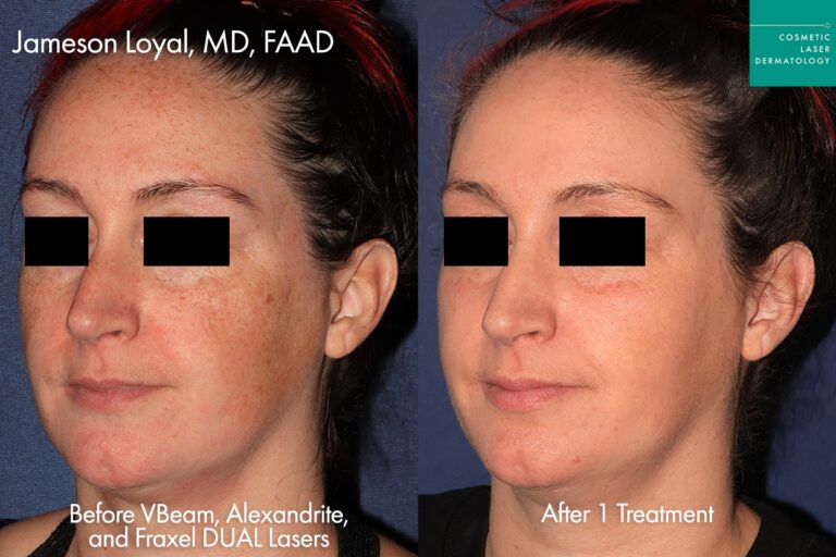 vbeam prima treatment for face female before and after clderm san diego