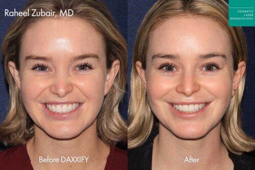 Daxxify before and after photos of a female patient at CLDerm, San Diego
