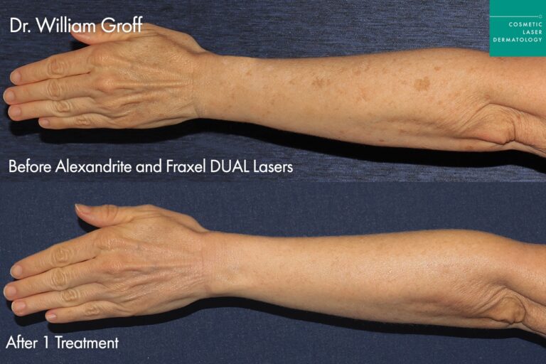 Hand rejuvenation before and after Fraxel Dual laser treatment, reducing age spots, fine lines, and improving skin texture.