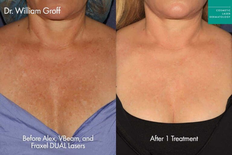 fraxel dual treatment before and after female results clderm san diego