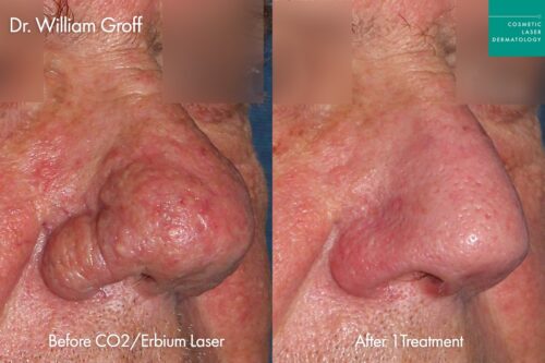 Male patient's nose before and after CO2 laser resurfacing in San Diego to treat nasal redness