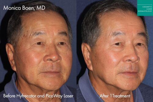 Male patient results following laser skin resurfacing in San Diego