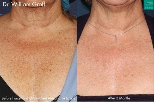 chest wrinkles treatment female before and after clderm san diego