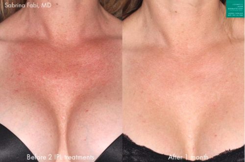 chest wrinkles treatment female before and after clderm san diego