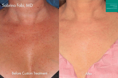 chest wrinkles treatment female before and after clderm san diego