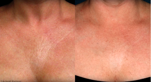 chest wrinkles treatment female before and after clderm san diego