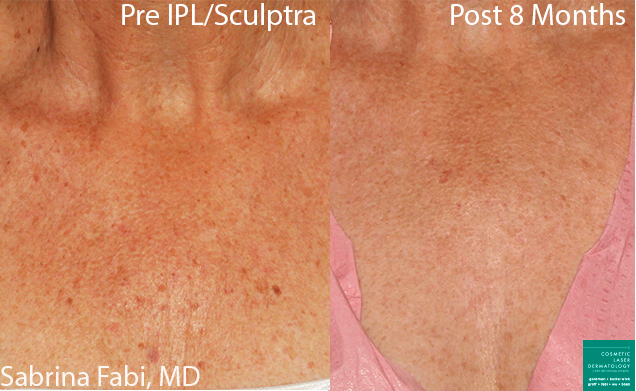 chest wrinkles treatment female before and after clderm san diego