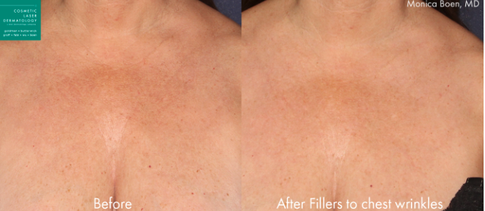 chest wrinkles treatment female before and after clderm san diego