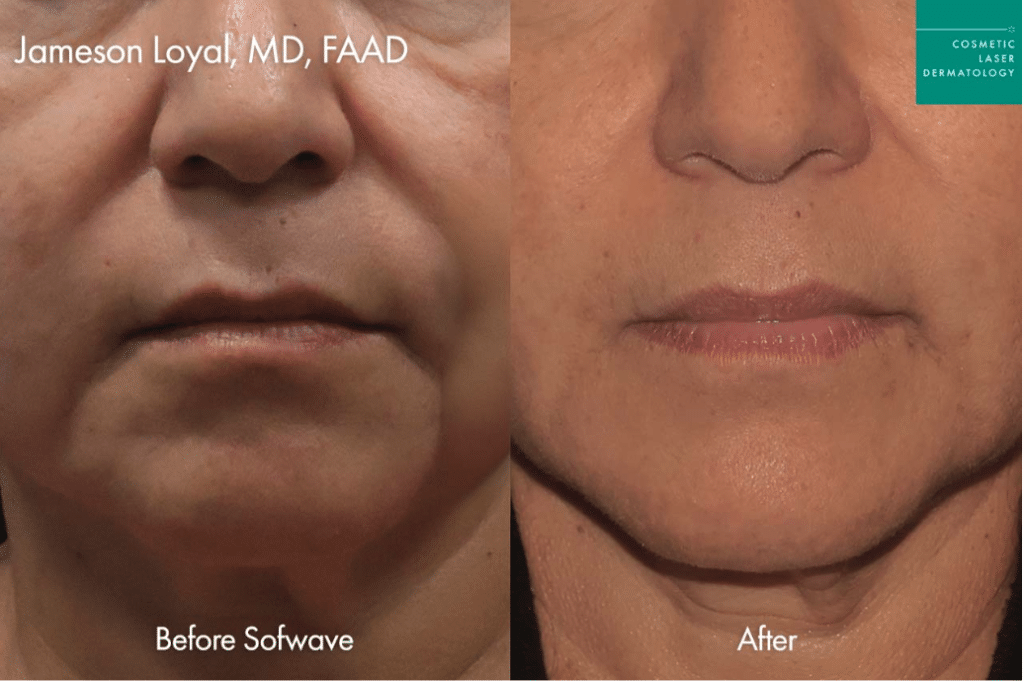 Woman receiving Sofwave skin-tightening ultrasound treatment at Cosmetic Laser Dermatology in San Diego