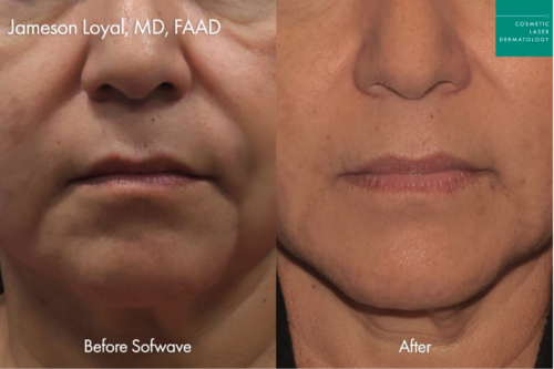 Woman receiving Sofwave skin-tightening ultrasound treatment at Cosmetic Laser Dermatology in San Diego