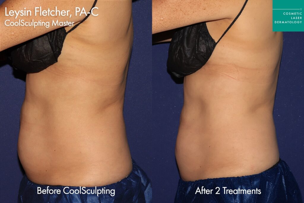 Patient before and after coolsculpting in San diego
