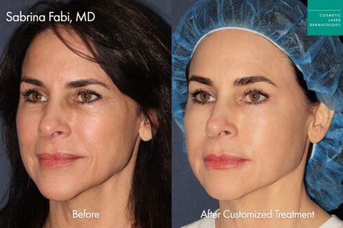 before and after sculptra in san diego