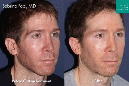 Male patient before and after custom cosmetic treatment plan in San Diego