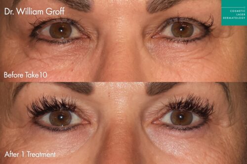Close up of female patient's eyes before and after eye rejuvenation with Take10Eyes in San Diego