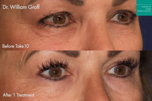 Female patient Take10Eyes results before and after eye rejuvenation in San Diego
