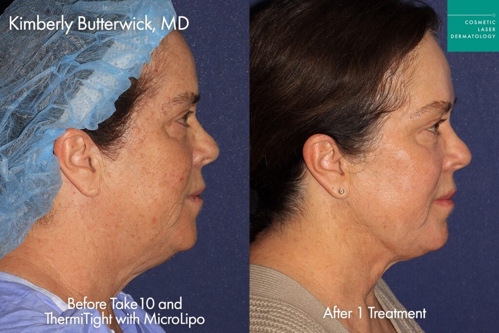 Female patient neck rejuvenation results before and after treatment in San Diego