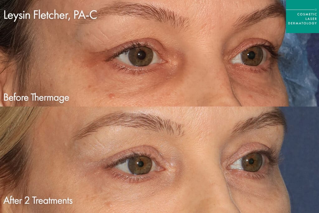 Thermage for skin tightening by Leysin Fletcher, PA-C. After treatment, the patient has an overall more lifted look, especially in the jawline.