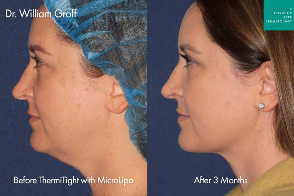 Thermisculpt treatment before and after results as performed by Dr. Groff at cosmetic laser dermatology