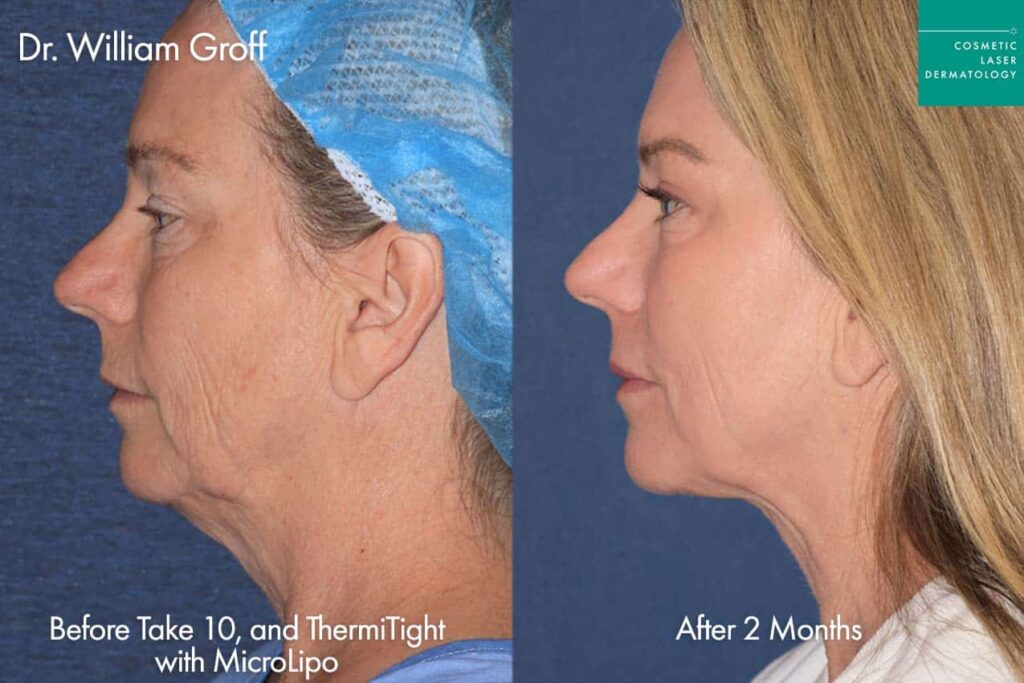 ThermiSculpt treatment before and after results as performed by Dr. Groff at cosmetic laser dermatology