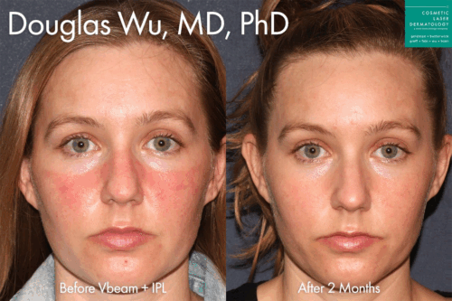 cosmetic laser dermatology ipl photofacial before and after san diego ca