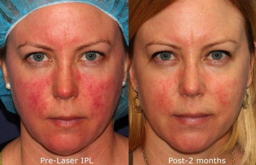 cosmetic laser dermatology vbeam prima versus lumenis ipl for rosaccea and redness before and after san diego ca