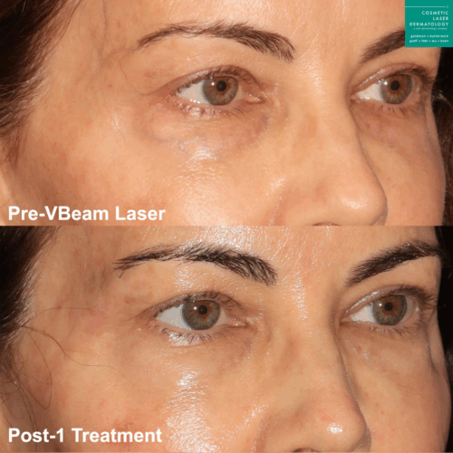 cosmetic laser dermatology vbeam prima before and after san diego ca