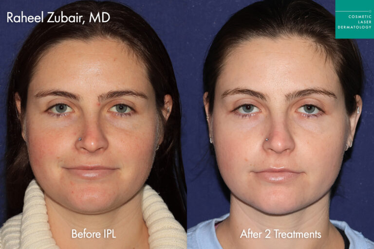 cosmetic laser dermatology vbeam prima versus lumenis ipl for rosaccea and redness before and after san diego ca