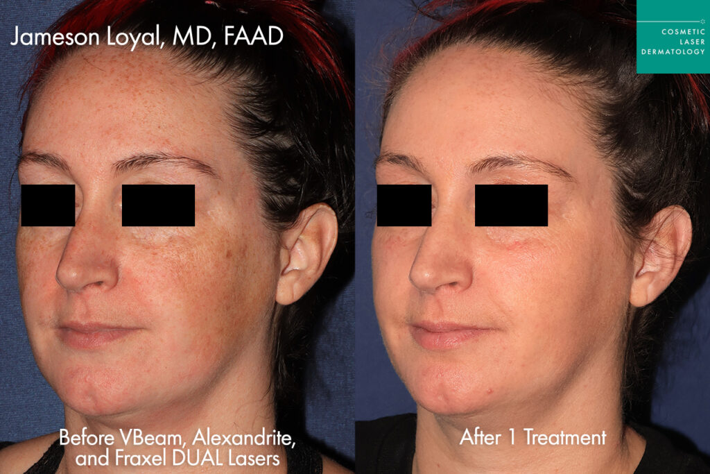 cosmetic laser dermatology vbeam prima versus lumenis ipl for rosaccea and redness before and after san diego ca