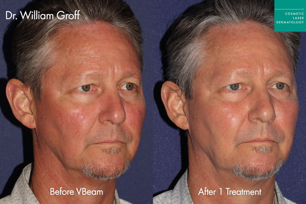 cosmetic laser dermatology vbeam prima versus lumenis ipl for rosaccea and redness before and after man san diego ca