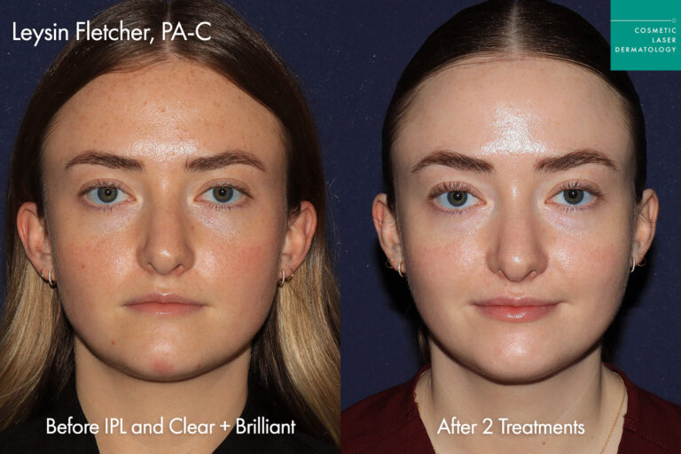 cosmetic laser dermatology vbeam prima versus lumenis ipl for rosaccea and redness before and after san diego ca