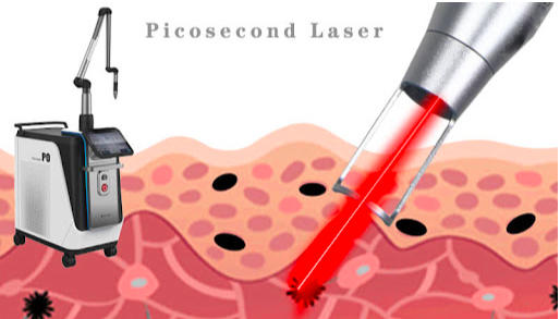Picosecond Laser image