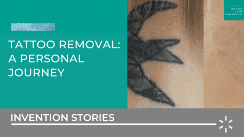 tattoo removal a personal journey before and after photo blog post hero image