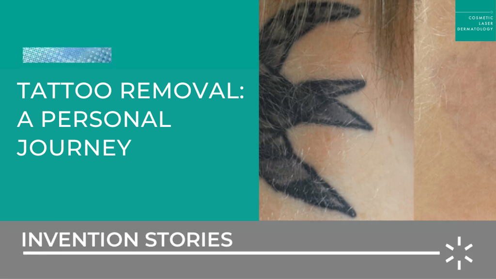 tattoo removal a personal journey before and after photo blog post hero image