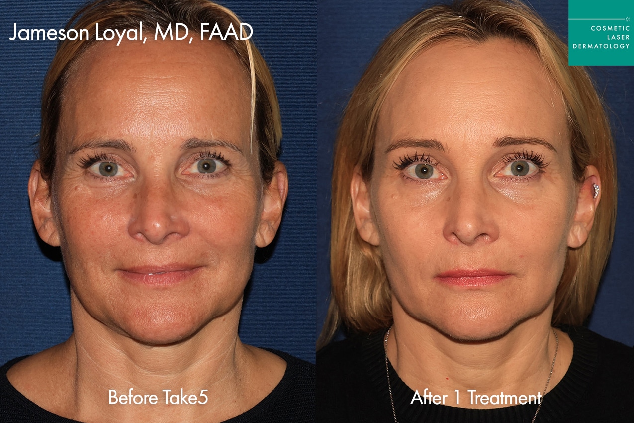 Take5 Before and After Image