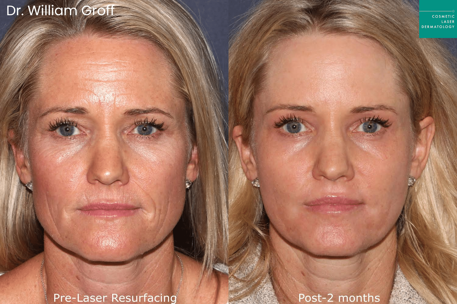 Dr. Groff Take10 Before and after