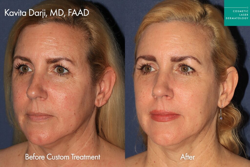 Real patient results before and after laser skin resurfacing in San Diego