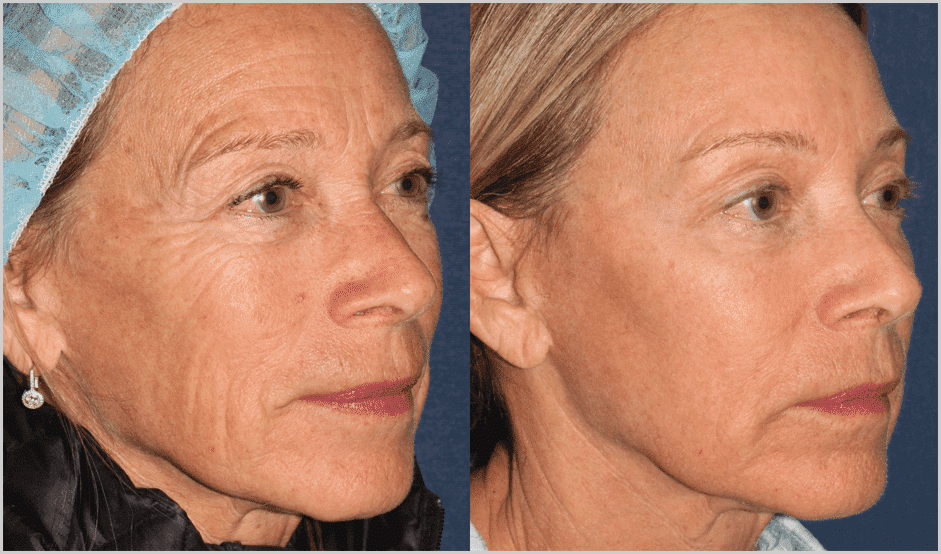 fraxel treatment before and after female results clderm san diego