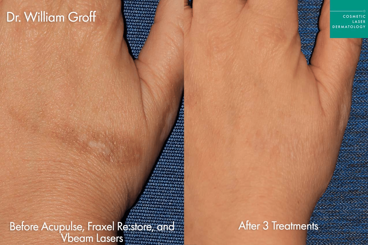 fraxel treatment before and after hand results clderm san diego