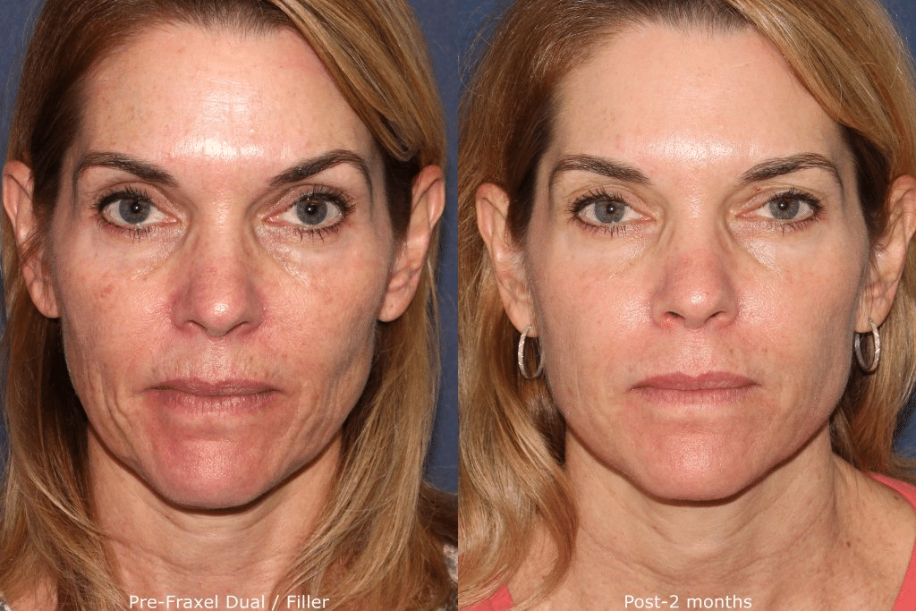 Fraxel laser before and after treatment.