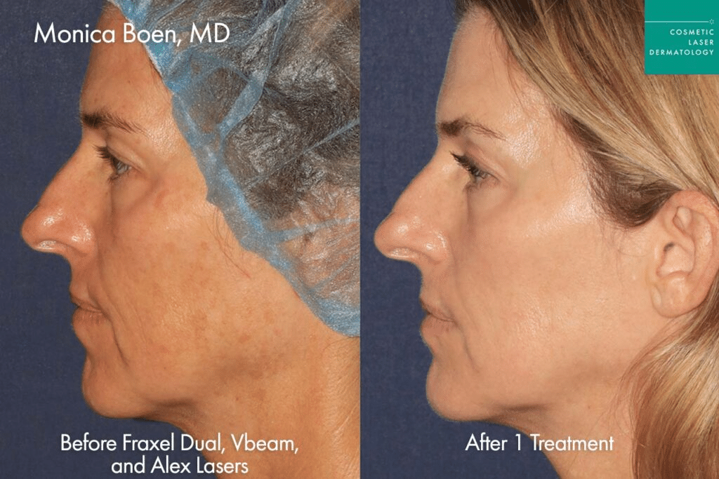 Fraxel laser results in San Diego